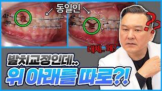 20년 경력의 교정의사의 발치교정 케이스 리뷰!