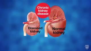 Mayo Clinic Minute: Innovative research to fight kidney disease