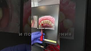 Почему зубы идеальные у тех, кто их не чистит #имплантациязубовмосква  #зубнойкамень