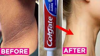 How To Get Rid Of a Dark Neck | Natural And Easy Brown Skin Treatment Around The Neck