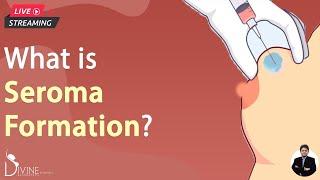 What Is Seroma Formation?