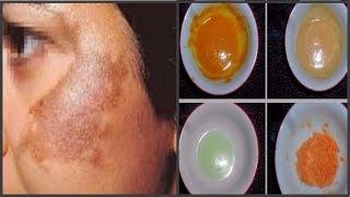 মেছতা দূর করতে ৪ ধরনের বিশেষ প্যাক/How to remove Melasma spot on your face