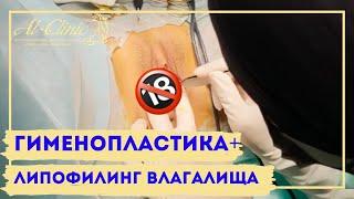 ГИМЕНОПЛАСТИКА  | ВОССТАНОВЛЕНИЕ ДЕВСТВЕННОЙ ПЛЕВЫ