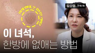 검버섯 없애는 최고의 방법 NO.1 l 검버섯 레이저
