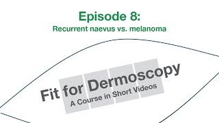 Fit for Dermoscopy Episode 8 – Recurrent naevus vs. melanoma