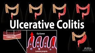 Ulcerative Colitis: Pathophysiology, Symptoms, Risk factors, Diagnosis and Treatments, Animation.