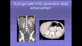 SIR-RFS Webinar (3/7/13): Diagnosis and Management of Renovascular Hypertension in Children