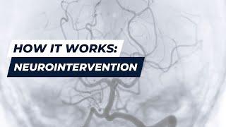 How Neurointervention Works | AuroraBayCare Interventional Neurology | Green Bay