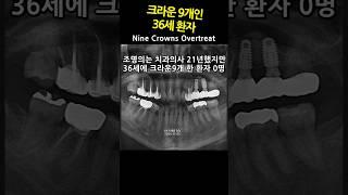 크라운 9개인 36세 환자. 크라운 과잉진료의 실체 31_2024_11_11