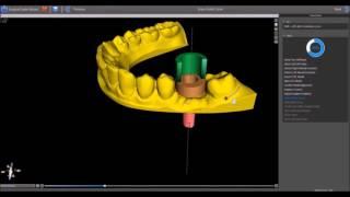 BSP WIZARD - CT to Surgical Guide in Minutes