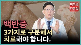 백반증은 3가지로 구분해서 치료해야 합니다ㅣ백반증 치료방법