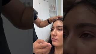 lip filler complete process with dr abbas ashrafzade
