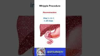 The Whipple Procedure (Pancreaticoduodenectomy): How To Do It (In Twenty Steps!)