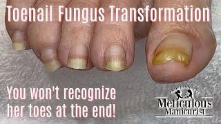 Pedicure How to Make a Toenail with Fungus Look Normal