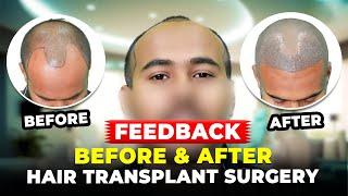 Best Hair Transplant In Ahmedabad || Cost & Result of Hair Transplant in Ahmedabad @hfhg clinic