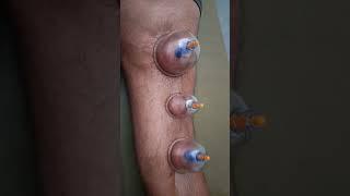 leg pain cupping therapy