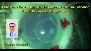 A Challenge Case of Intumescent Cataract Phacoemulsification Using The CapsuLaser Technology