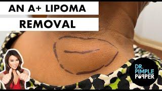 An A+ Lipoma Removal