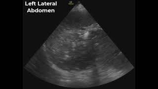 Gastric Distention