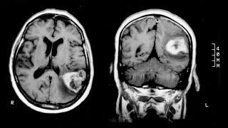 GERSTMANN SYNDROME: What is it?- Signs, Symptoms, Treatment, Causes, Agraphia-Acalculia-Agnosia