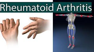 Rheumatoid Arthritis - Symptoms, Causes, Risk factors and Treatment
