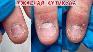 Horrible cuticles and burrs / Picking finger skin