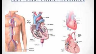 Medical Coding - How to code a LHC