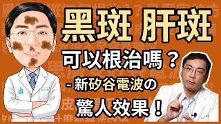 黑斑、肝斑、老人斑，最有效的治療方法是什麼？如何才能根治？最新矽谷電波 (Sylfirm) 效果超驚人！皮膚暗沉，思膚安電波也有效！