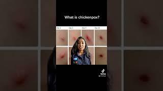 What is chickenpox?