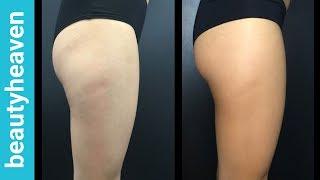 I Tried A Cellulite Treatment And It Actually Worked!