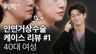 안면거상수술 케이스 01 - 40대 여성
