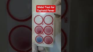 Widal Test for Typhoid and Paratyphoid Fever | Salmonella Agglutination Test