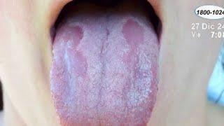 “Candidiasis oral”: ¿Qué es y cómo tratarla?