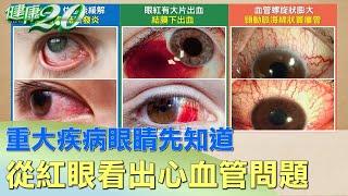 重大疾病眼睛先知道 從紅眼看出你的心血管問題 健康2.0