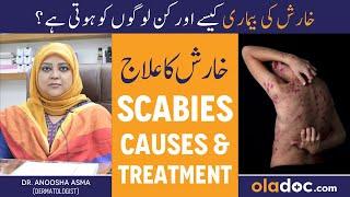 KHARISH KA ILAJ - Scabies Treatment In Urdu - Kharish Ki Bimari Kyun Hoti Hai - Itching Solution