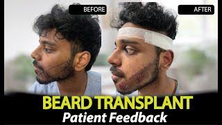 Beard Transplant Surgery in Jaipur | Rejuvena Cosmo Care by Dr. Deepesh Goyal