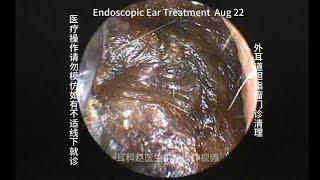 Cleaning of severely blocked external auditory canal cholesteatoma