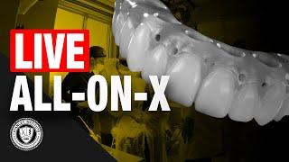 LIVE ALL-ON-X Guided Procedure | Stanley Institute