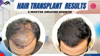 Hair Transplant In Kerala | Best Center Results Cost & Surgeon Of Hair Transplant In Kerala