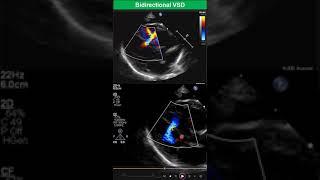 Bidirectional Ventricular Septal Defect- Early Stage of Eisenmenger Syndrome