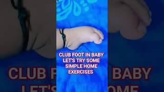 club foot,CTEV, simple home exercises for babies #trending #ytshorts #babygirl