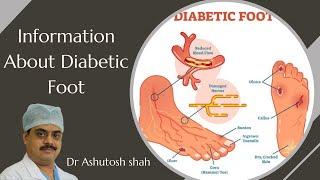 Information About Diabetic Foot its Care, Reasons, Causes, and Treatment by Dr  Ashutosh Shah Surat