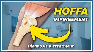 How to diagnose and treat hoffa impingement?