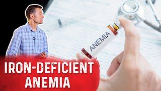 Taking Apple Cider Vinegar For Iron Deficiency Anemia – Dr. Berg