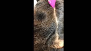 EXTREME HEAD LICE REMOVAL