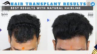 Hair Transplant In Salem | Best  Center Surgeon Clinic & Results Of Hair Transplant In Salem