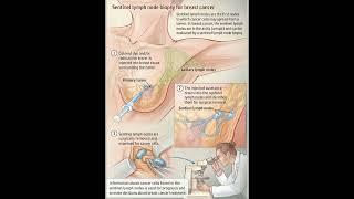 Sentinel Lymph Node Biopsy for Breast cancer!!! Dr Gohar Shahroz #doctor #medical #short