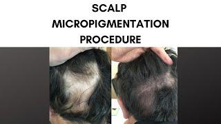 Scalp Micropigmentation Procedure at Parsa Mohebi Hair Restoration