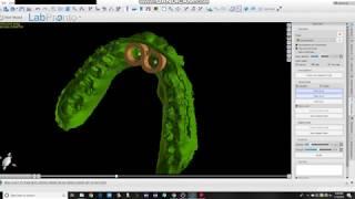 Blue Sky Bio Fabrication of a Tooth Supported Implant Guide