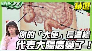 你的「大便」長這樣，代表大腸癌變了！名醫這樣吃遠離腸癌！【健康2.0精選】